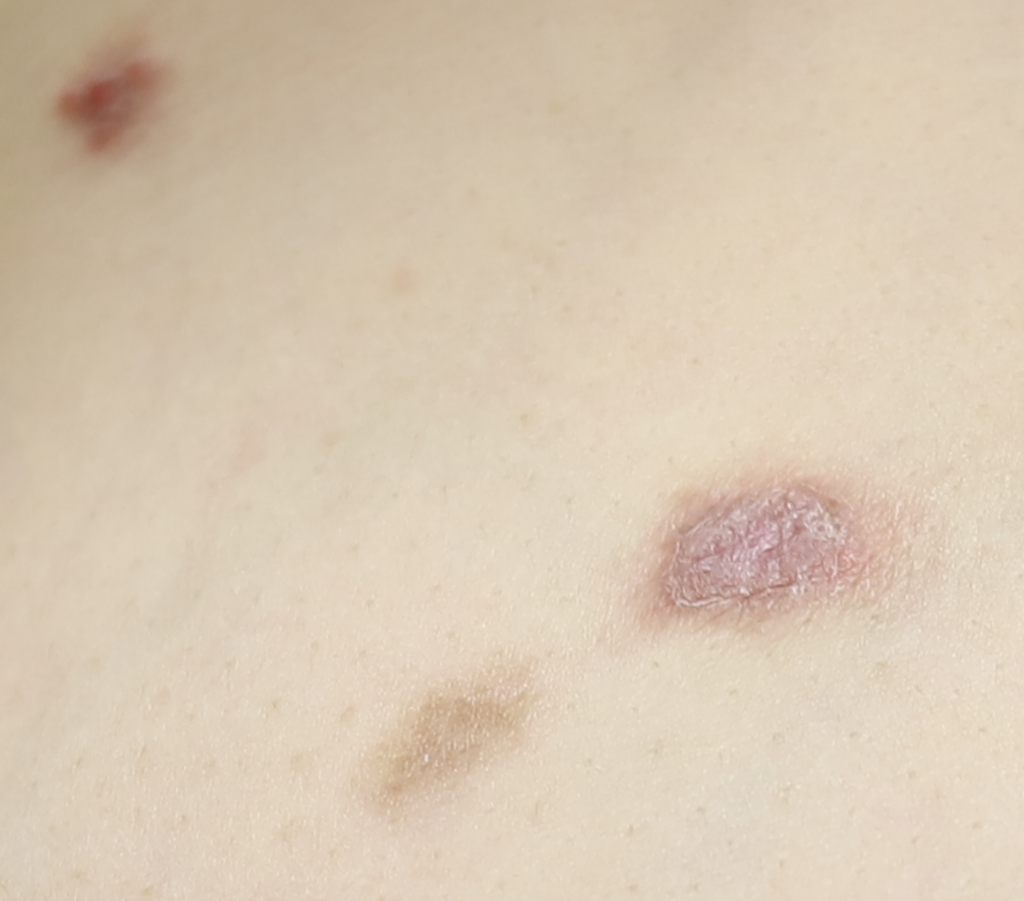 psoriasis silver plaque